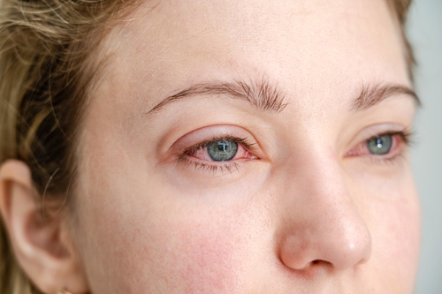 Close up of the red irritated human eyes, allergy symptom, conjunctivitis
