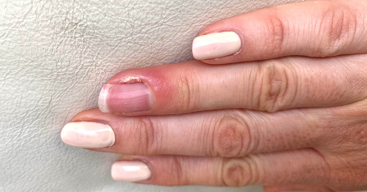 Guide to Paronychia: Exploring Its Causes, Recognizing the Symptoms, and Getting a Proper Diagnosis