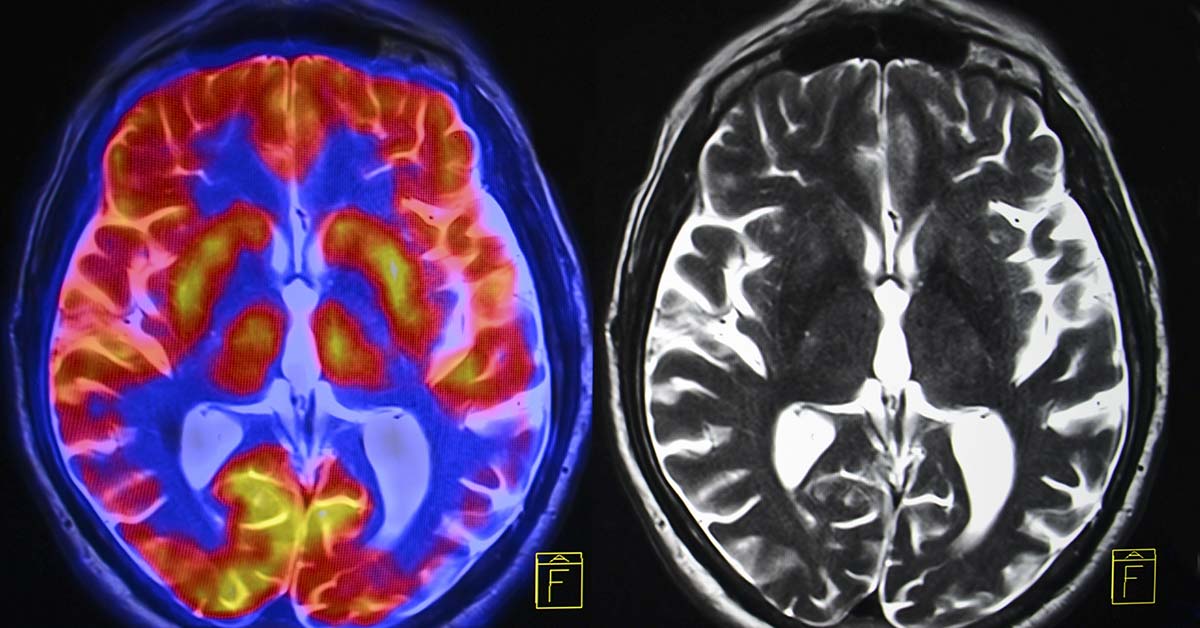 Study Pinpoints Three Major Contributors to Dementia Risk