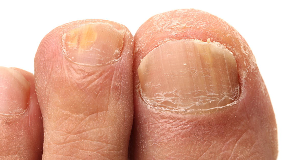 Thick Toenails: Treatments and Home Remedies