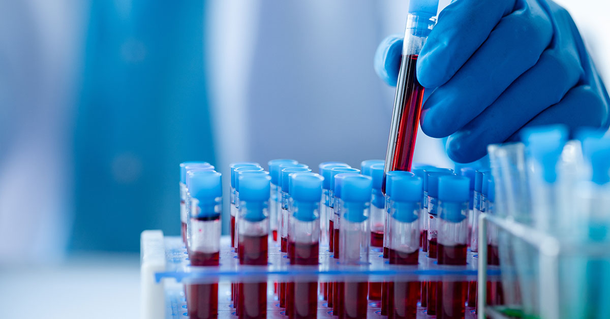 Study Finds People with Certain Blood Type Are Prone to Early Stroke