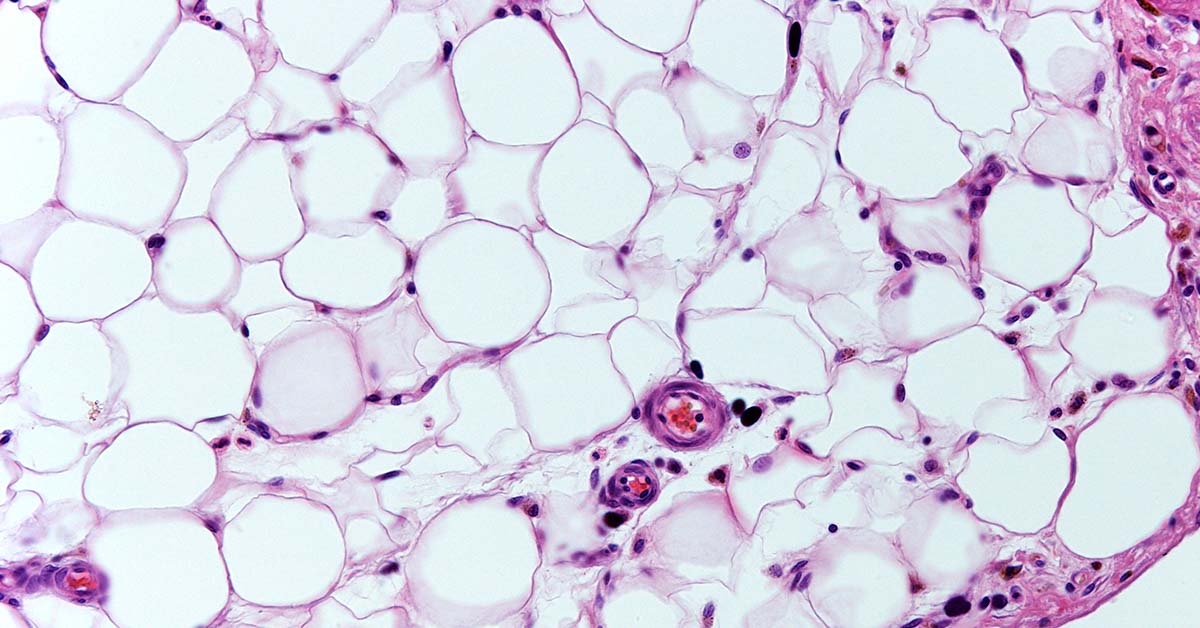 Fat Cells ‘Remember’ Obesity, Offering Clues to Why Weight Loss is So Challenging