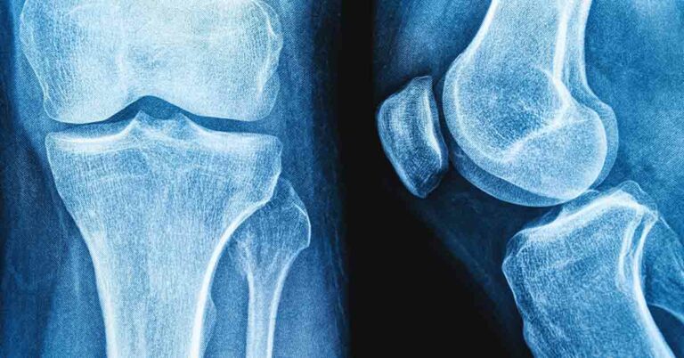 Do Soft Drinks Have a Negative Impact on Bone Health and Strength? - Featured image