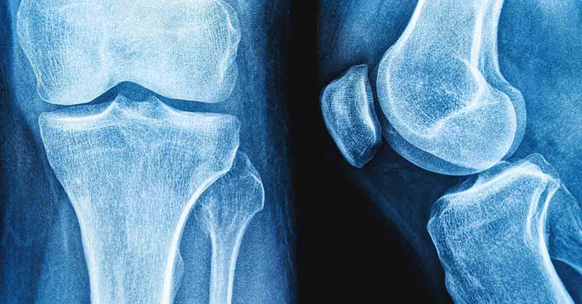 Do Soft Drinks Have a Negative Impact on Bone Health and Strength?