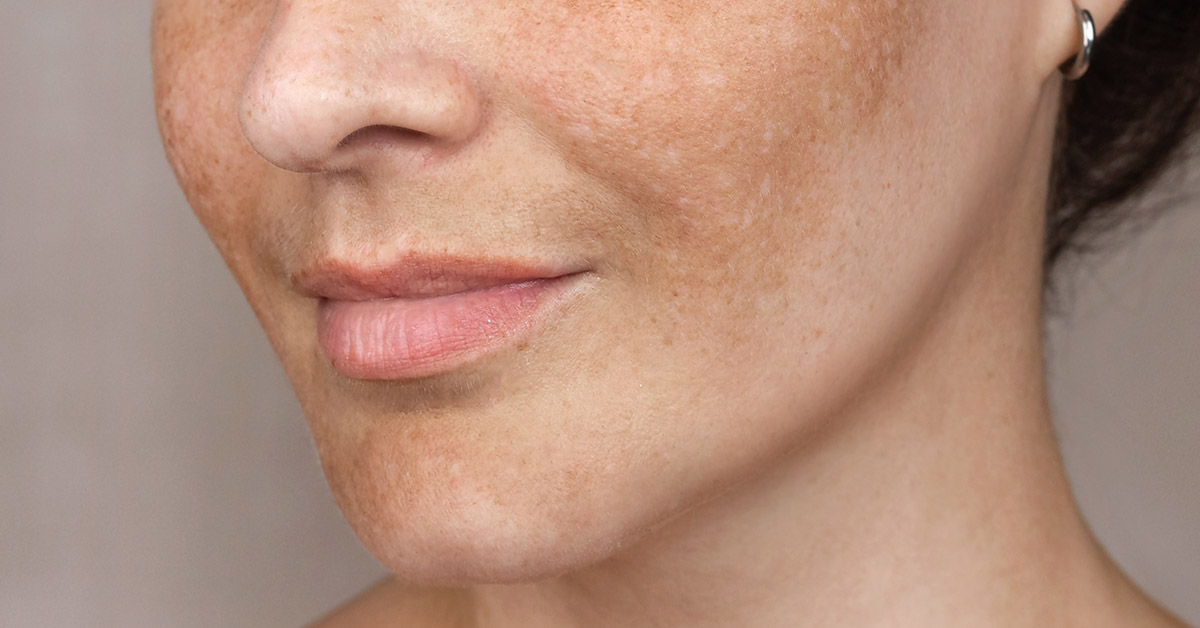 How To Reduce Age Spots: Causes, Treatment, and Prevention