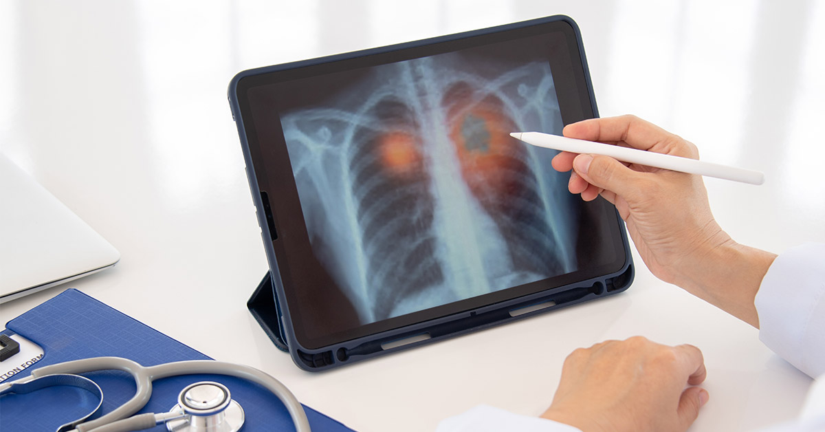 New Study Links High Sugar Diet to Lung Cancer, Shedding Light on Diet’s Role in Health