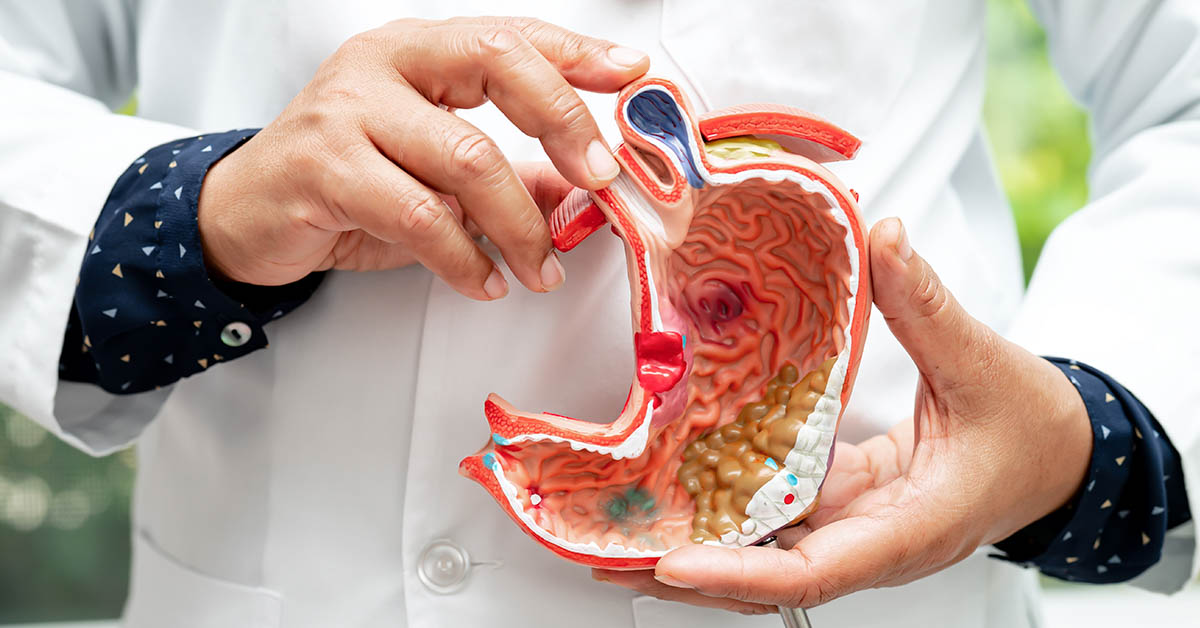 9 Crucial Signs of Stomach Cancer to Watch for and Treat Early