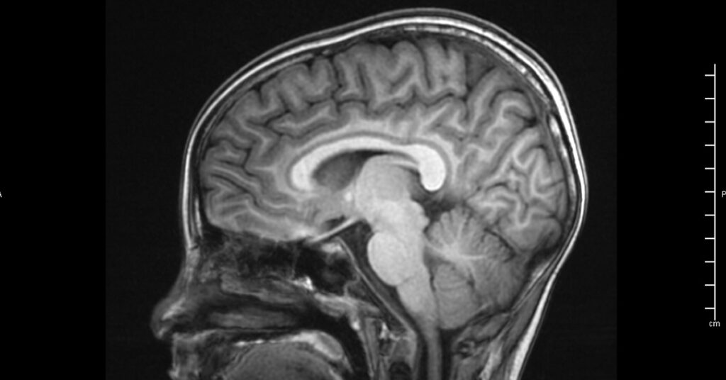Researchers Identify New Subtypes of Common Brain Disorder - Featured image