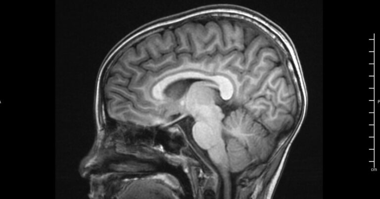 Researchers Identify New Subtypes of Common Brain Disorder - Featured image