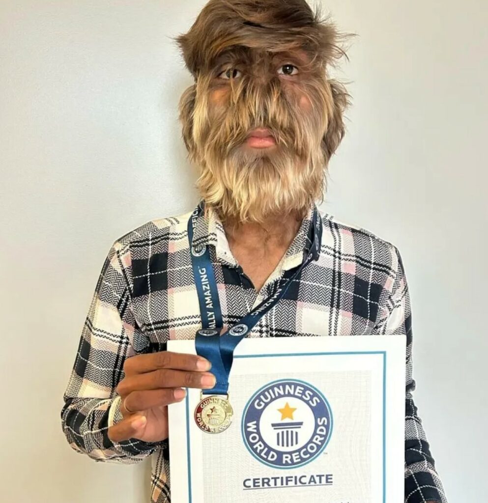 Lalit Patidar holding Guinness World Records award certificate for Werewolf Condition
