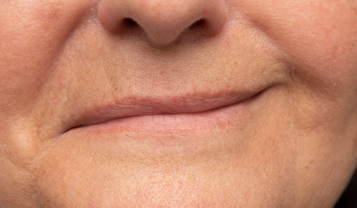 Close-up of a woman's mouth smiling. Evident asymmetry of the lips due to a hemiparesis of the face. Case of Bell's palsy caused by inflammation of the facial nerve. Paresis from cold snap