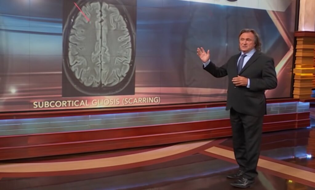brain scarring
