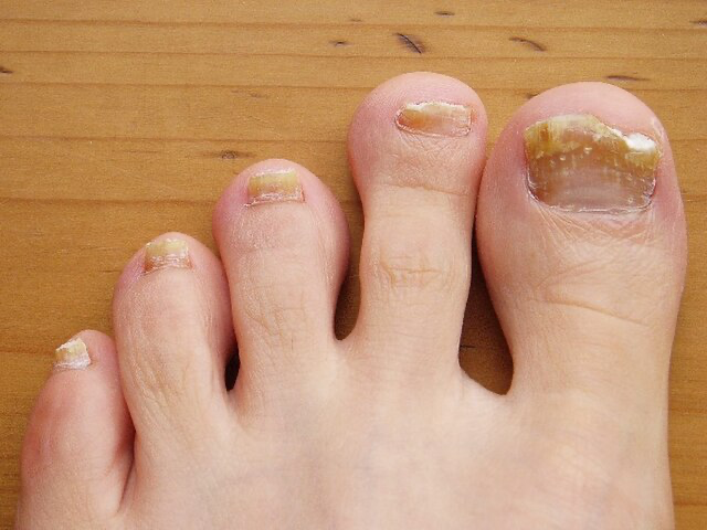 A close-up of a person's toe showing a thickened nail affected by fungus, highlighting common causes of nail thickening.