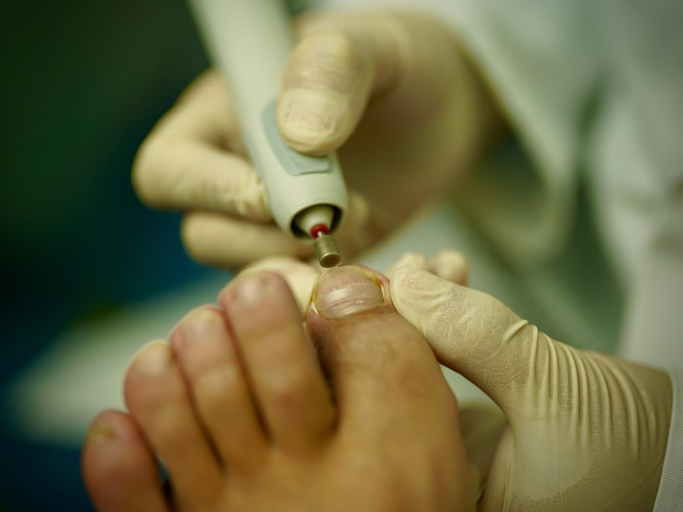 A doctor trims a patient's toenail with an electric nail filer, highlighting the importance of monitoring toenail health for potential issues.