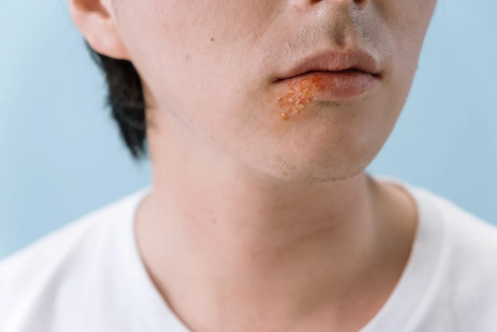 Close-up of oral herpes lesion on a person's lip, showing the characteristic blisters associated with HSV-1 infection. Research links this common virus spread through sexual practice to increased dementia risk later in life.