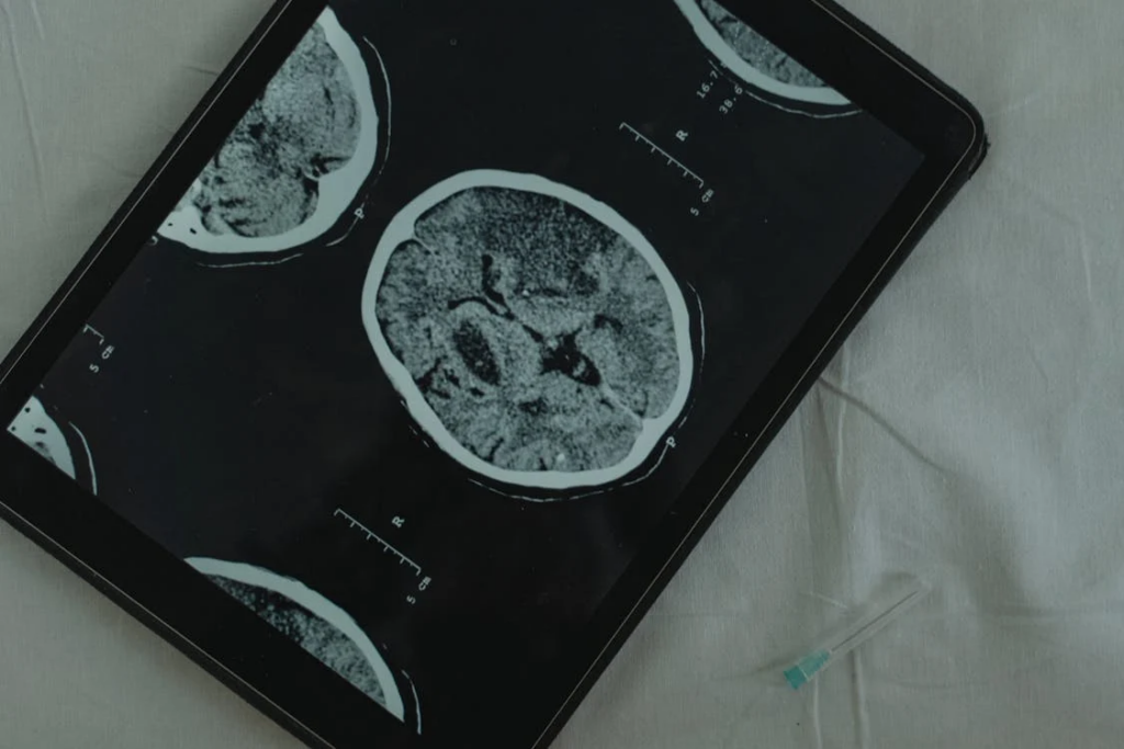 Brain scan showing cross-section of neural tissue that may reveal changes associated with dementia. Recent studies suggest certain sexual practices that transmit viruses like herpes may influence dementia risk in aging populations.