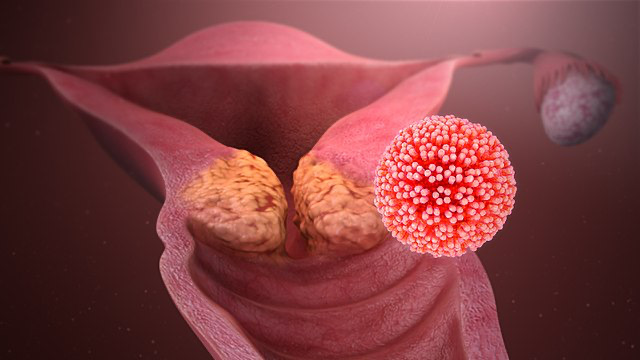 Visual representation of a woman's ovary and a cell, illustrating the progression from normal cells to cervical cancer.