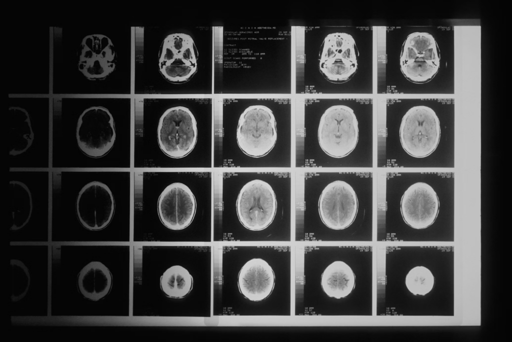 A comprehensive grid of brain scan images showing multiple cross-sections of a human brain from different angles and positions. These types of medical images are crucial for studying neurological conditions like Alice in Wonderland Syndrome, helping visualize the brain regions involved in perception distortions.