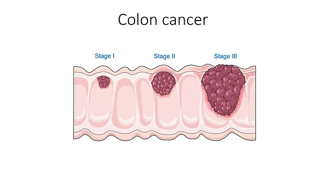 A medical illustration showing three stages of colon cancer progression. The diagram depicts a cross-section of colon tissue with increasingly larger growths labeled as Stage I, Stage II, and Stage III, demonstrating how colon cancer symptoms develop as the disease advances.