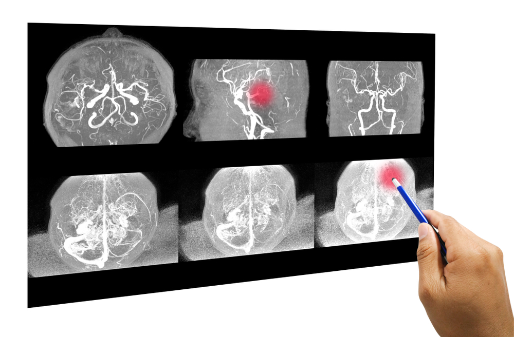 MRA brain or Magnetic resonance angiography of cerebral artery in the brain with habd doctor pointed out that abnormal blood vessels in the brain.Medical and healthcare concept.Selective focus.