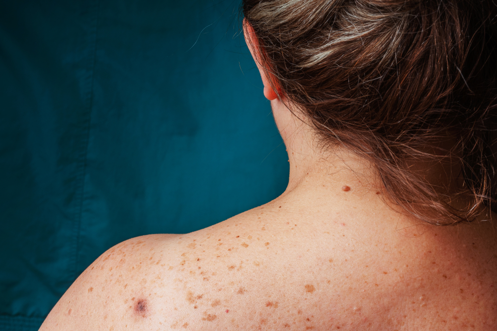 Age spots, moles, and freckles on the back of an older woman. Pigmentation on the back. Spots on the body
