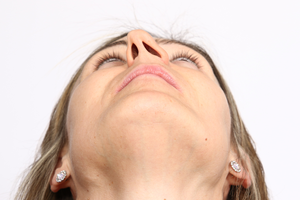 Closeup of deviated nasal septum severe septal deviation condition