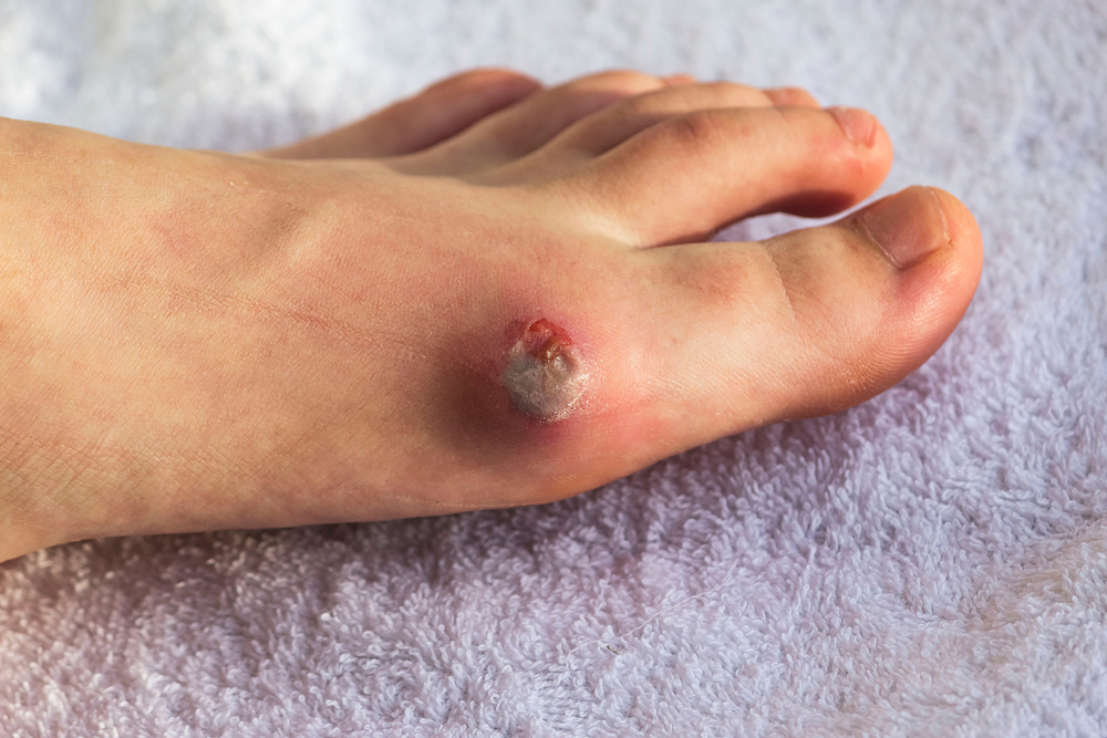 Diabetes mellitus of the foot. Infected wound, treatment of a diabetic patient's leg infection. Selective focus.