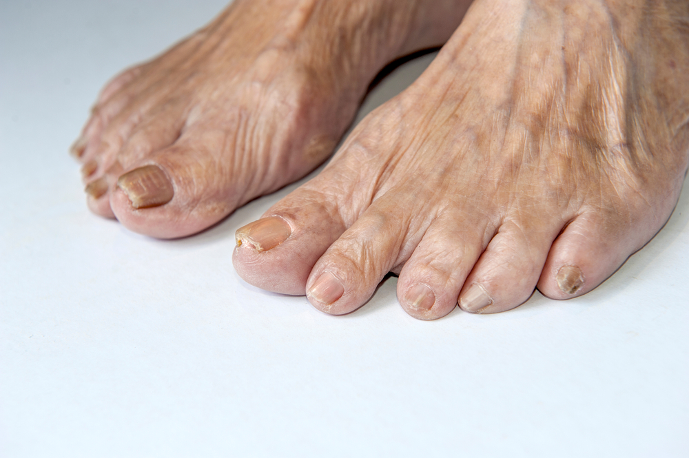 Closeup image of asian elderly foot Toe nail suffering from fungus infection on white background. Selective focus.