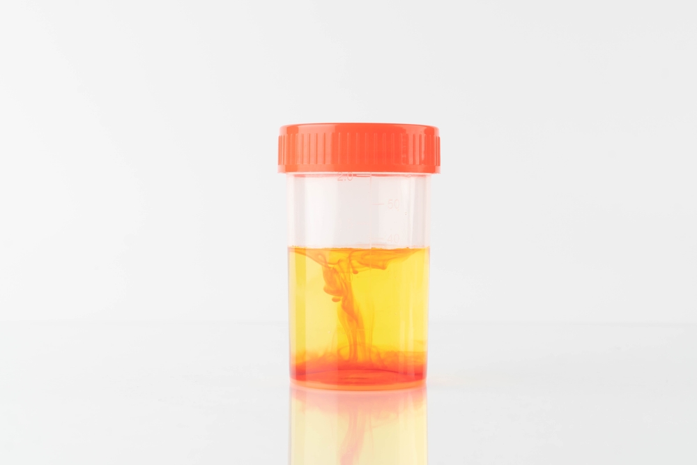 Blood in urine (hematuria) sample bottle in laboratory. Cause of hematuria included urinary tract infection, kidney infection, bladder stone, prostatitis or cancer.