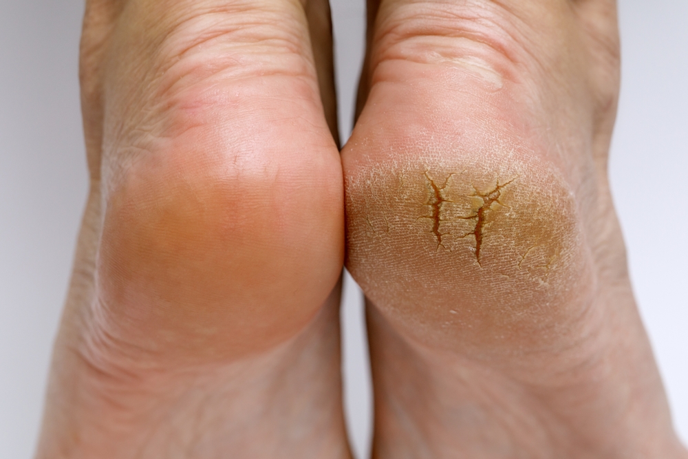 Cracked heels before and after treatment and treatment. Medical pedicure in a beauty salon. Problematic dehydrated feet with dry skin. Close-up photo of legs.