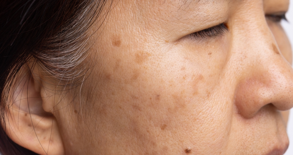 Menopausal women worry about melasma on face.
