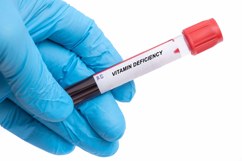 Vitamin Deficiency. Vitamin Deficiency disease blood test in doctor hand