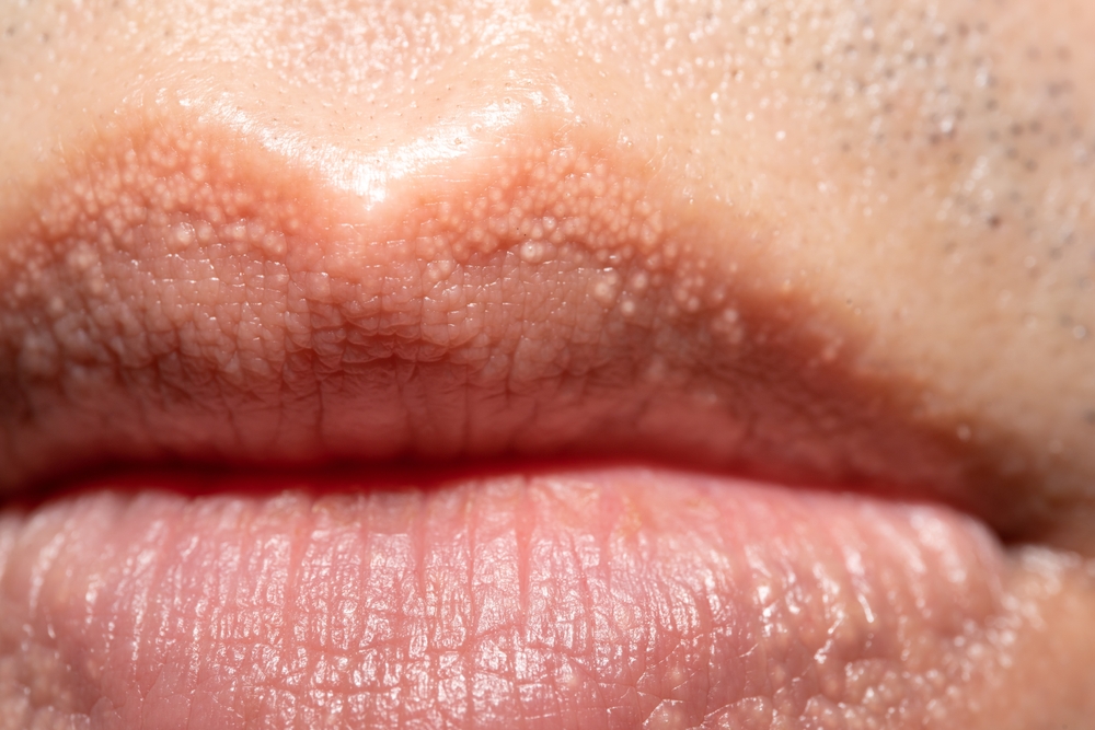 close up of Fordyce Spots on Lips.
