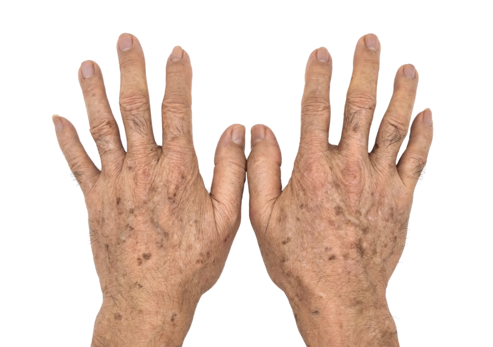 Age spots on hands of Asian elder man. They are brown, gray, or black spots and also called liver spots, senile lentigo, solar lentigines, or sun spots.

