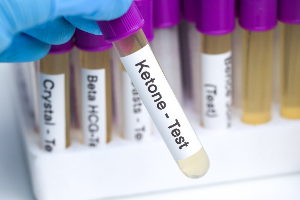 Urine samples for testing Ketones in the laboratory, urine sample in test tube