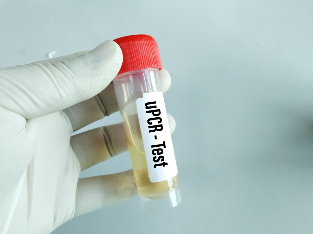 Urine Sample for Urine PCR(Protein-Creatinine Ratio).lab test of proteinuria related to chronic kidney disease (CKD).