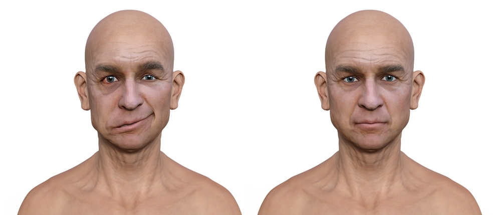 Facial palsy in a man and the same healthy man, photorealistic 3D illustration highlighting the asymmetry and drooping of the facial muscles on one side of the face
