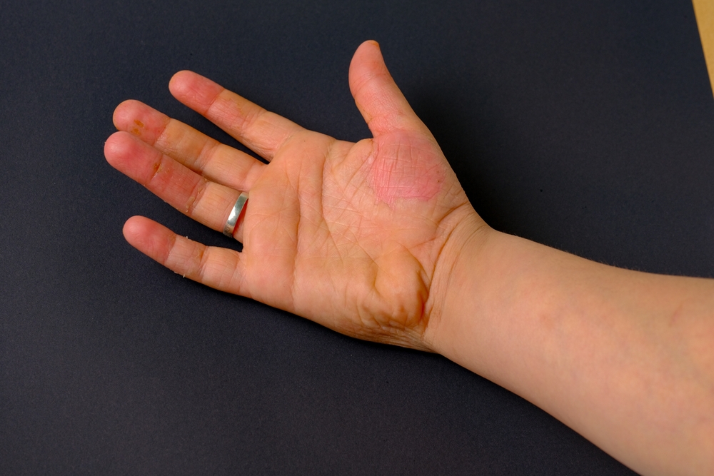 photo of boy hand with cutaneous problem causing peeling of skin
