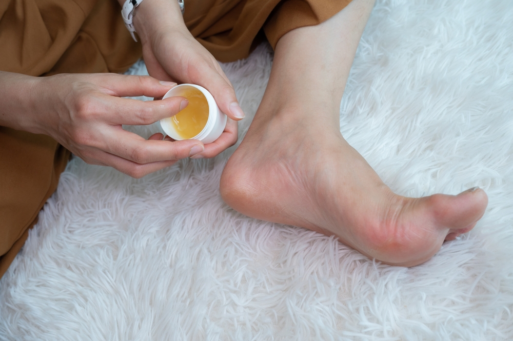 Close up of woman applying moisturizer cream for treat cracked heels problem. Cracked heels occur when dry, thick skin on the bottom of your heels cracks and splits.