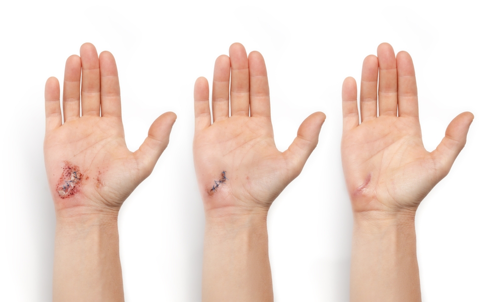 Wound healing visualization of hand with laceration and stitches. Female hand with sutured wound on day 3, day 10 and 4 weeks after the injury. Side by side healing stages or phases. Selective focus.