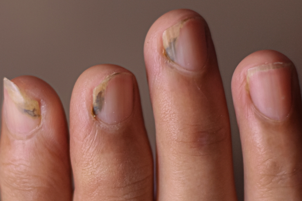 Onychomycosis, onycholysis, paronychia. Nail diseases, nail fungal infection. Injured yellow and green human fingernail..nail.fungus. injured finger, finger fungus, nail.infection, treatment, medical.