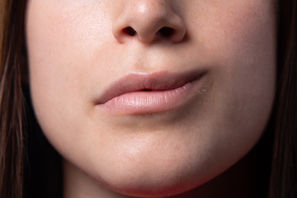 close-up of the mouth of a girl with hemiparesis, Bell's palsy. Forced smile across half face. Muscles paralyzed by inflammation of the facial nerve