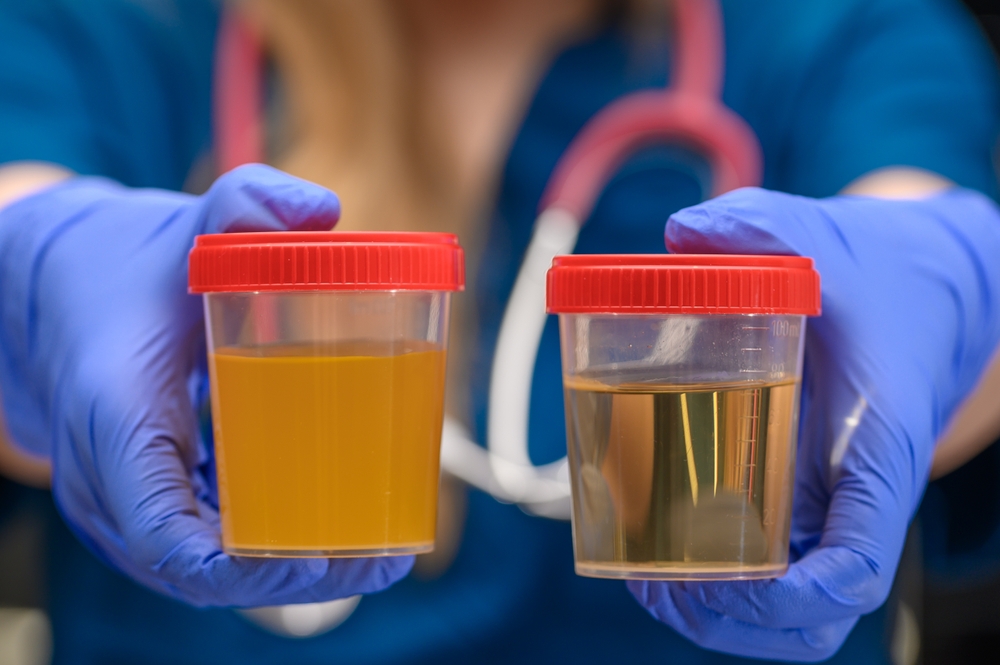 Urine test, the nurse holds urine containers in different colors and with different clarity