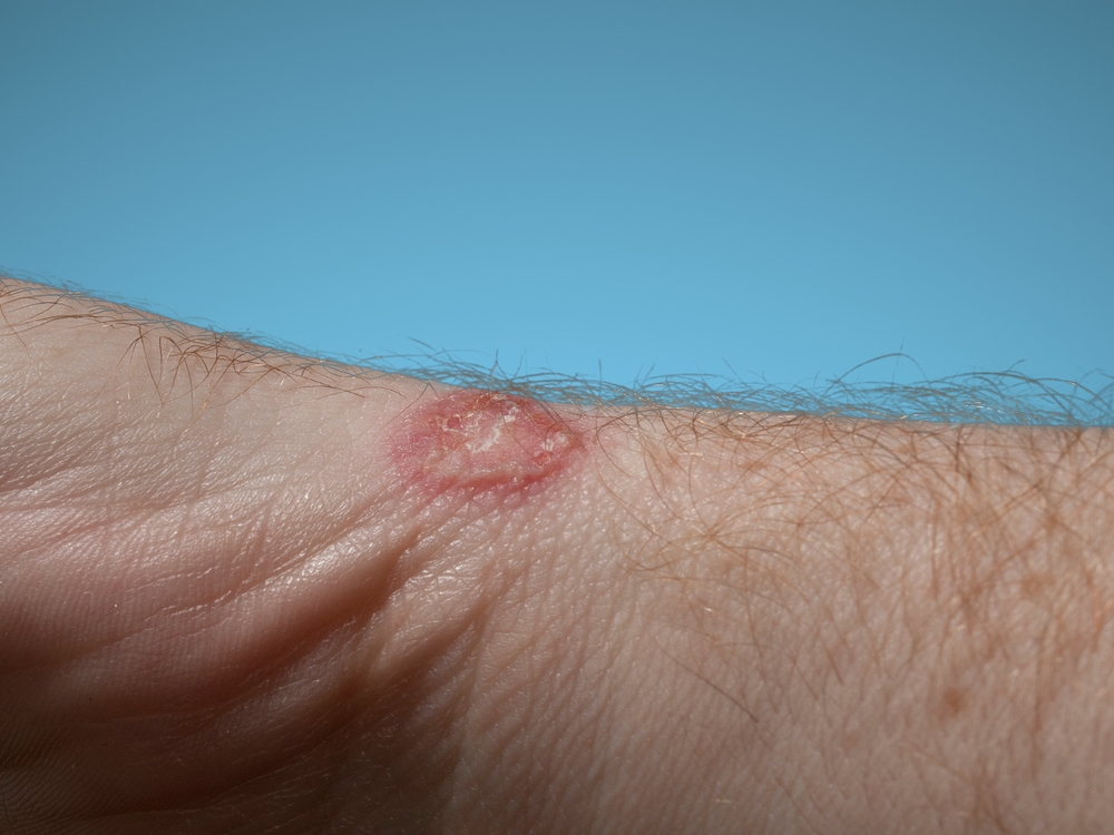 Closeup of ringworm infection or Tinea corporis on human hand skin isolated on light blue background background.