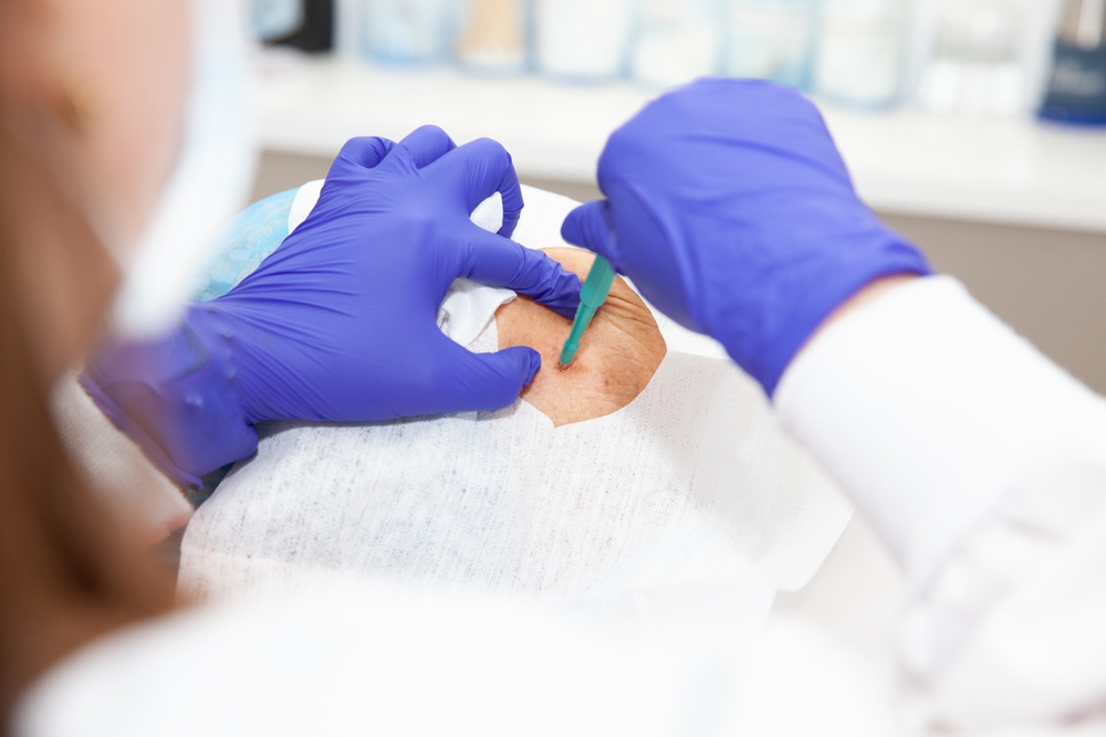 Dermatologist carrying out a skin biopsy on the face of a senior adult patient. Skin lesion removal procedure. Biopsy punch.
