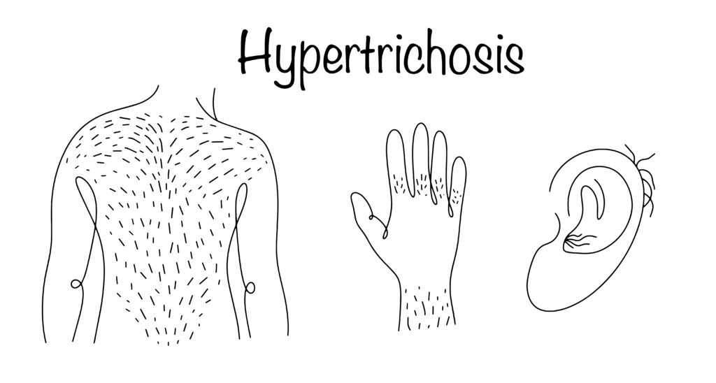 Hypertrichosis. A disease that manifests itself as excessive hair growth in various parts of the body. A line drawing of a man's back, fingers and ears with hair growing on them. Medical vector.