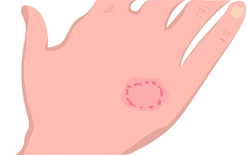 Hands with ringworm eczema psoriasis or Jock itch skin rash fungus tinea cruris dermatophytosis Itchy Scaly