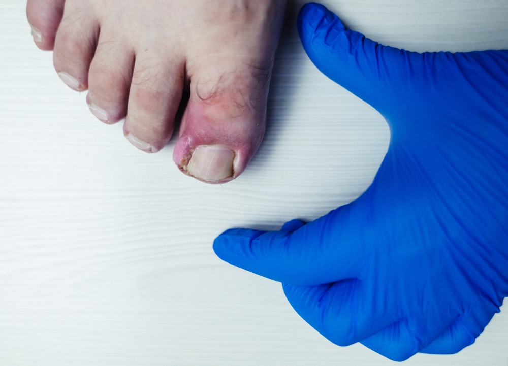Finger infection. Paronychia, onychomycosis, nail psoriasis, longitudinal melanonychia, onychomadesis and retronychia. Inflammation of the big toe. Treatment of purulent diseases.