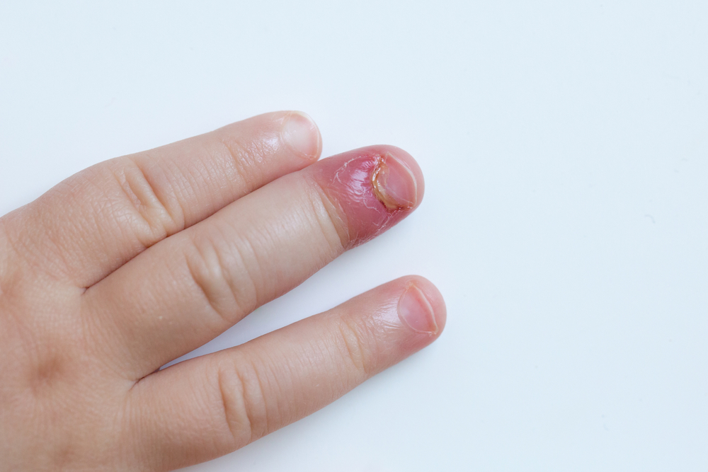 Paronychia, swollen finger with fingernail bed inflammation due to bacterial infection on a toddlers hand.