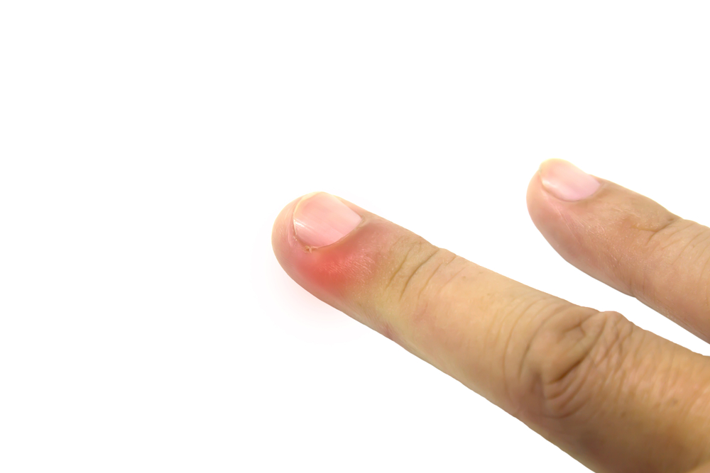 finger swollen with inflammation due to Nail ripped infection
